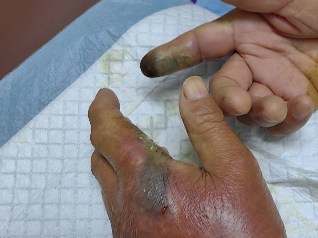 谢周三vs利兹联
_眼镜王蛇咬伤老人谢周三vs利兹联
,家属拖两米多长的“凶手”冲进医院!“拎蛇就医”可取吗?