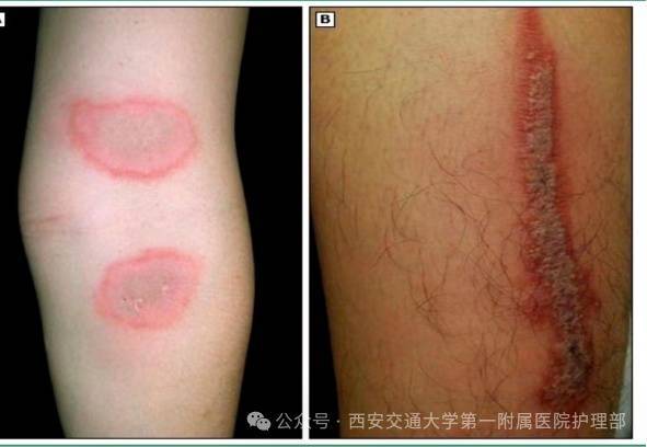 皇冠信用盘_西安多区发现隐翅虫?千万别拍皇冠信用盘!毒液堪比硫酸